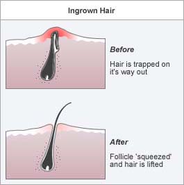 ingrown_hairs